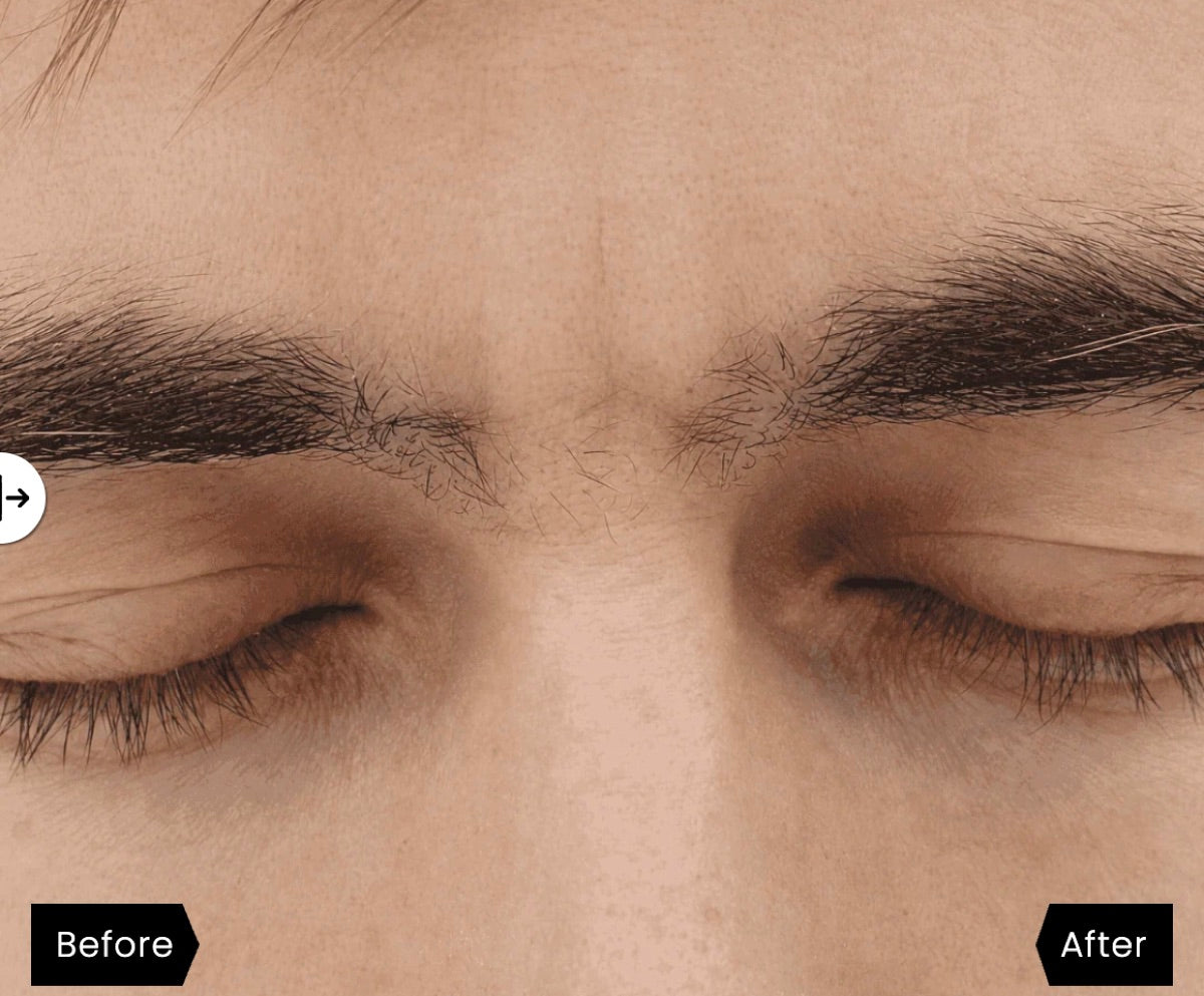 Forehead after: calm, clear skin