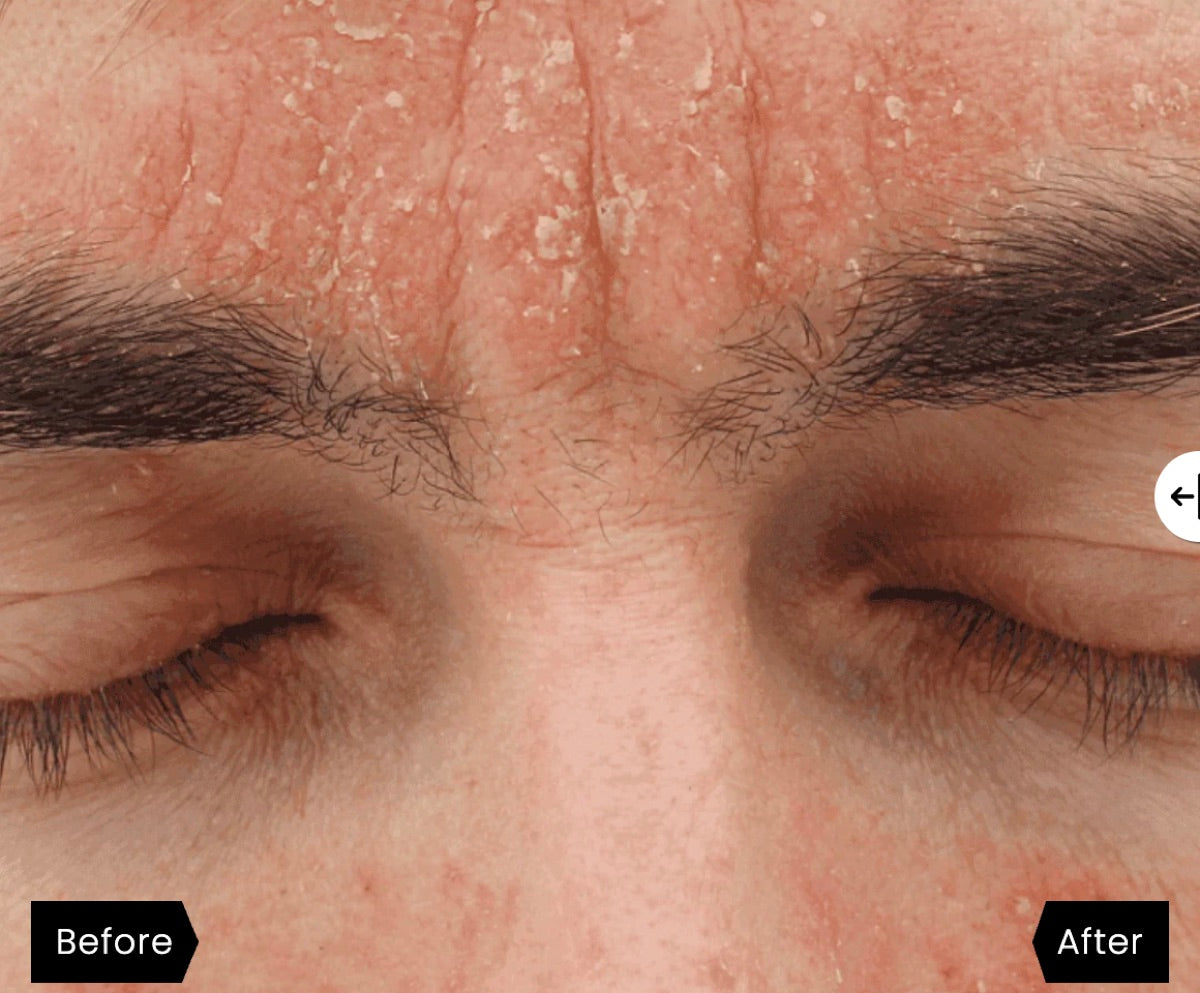 Forehead before: red, flaking skin