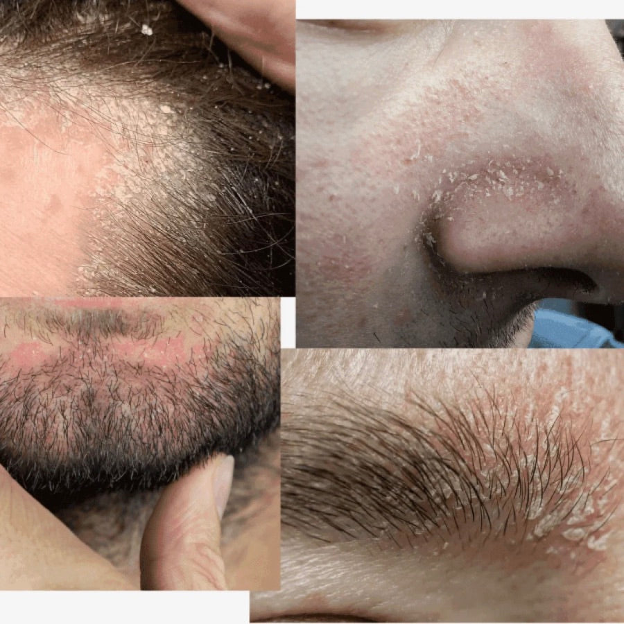 Close-ups of flaking, red skin on a scalp, nose, beard and eyebrow